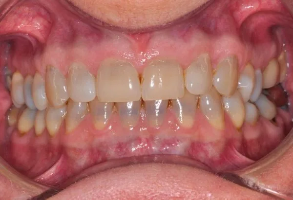 Before - Peacock Dental Spa