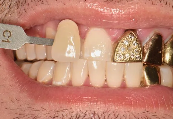 Before - Peacock Dental Spa
