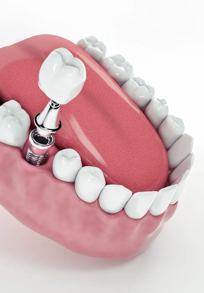 Treatment -  Peacock Dental Practice