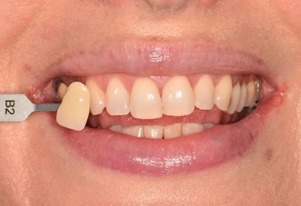 Before - Peacock Dental Spa