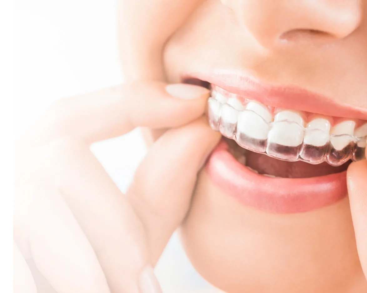 Invisalign